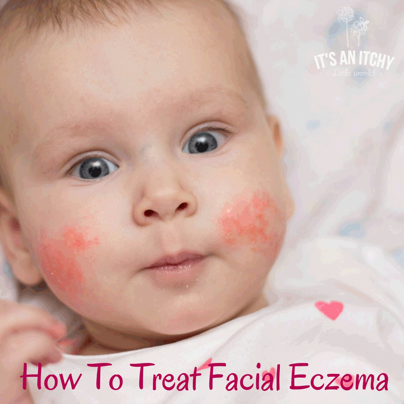 How-To-Treat-Facial-Eczema