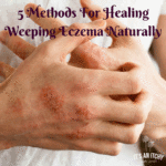 5-Methods-For-Healing-Weeping-Eczema-Naturally