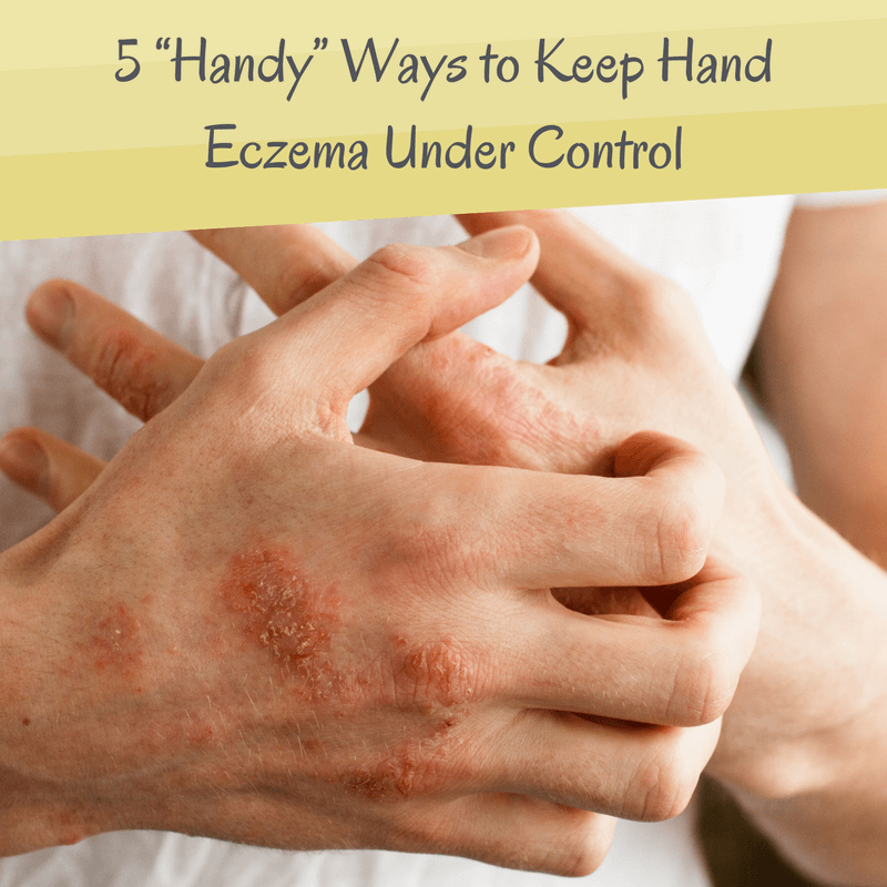 eczema hands