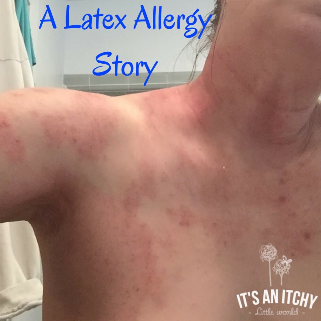 A Latex Allergy Story  It's an Itchy Little World