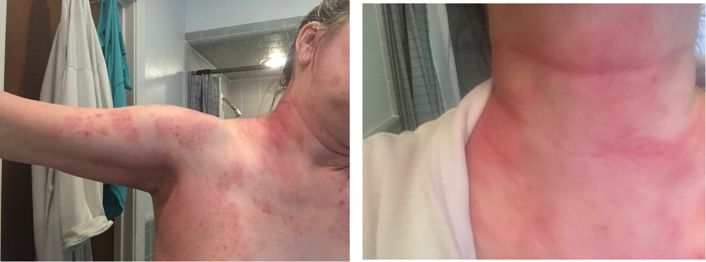 Latex Allergy - Recognize and Identify an Allergic Reaction