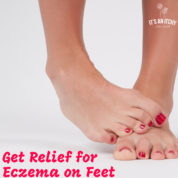 Eczema on Feet
