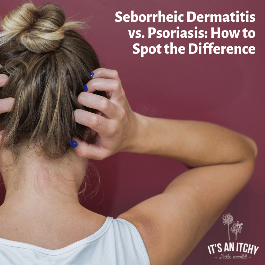 seborrheic dermatitis vs. psoriasis, psoriasis seborrheic vs. dermatitis, seborrheic dermatitis vs. psoriasis scalp