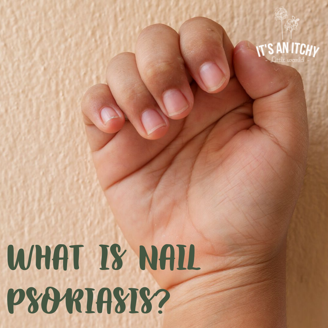 Is Psoriasis Damaging Your Nails?