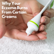 Why Your Eczema Burns From Certain Creams-min