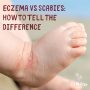 eczema vs scabies